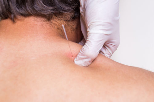 Trigger-point dry needling