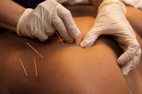 Trigger-point dry needling